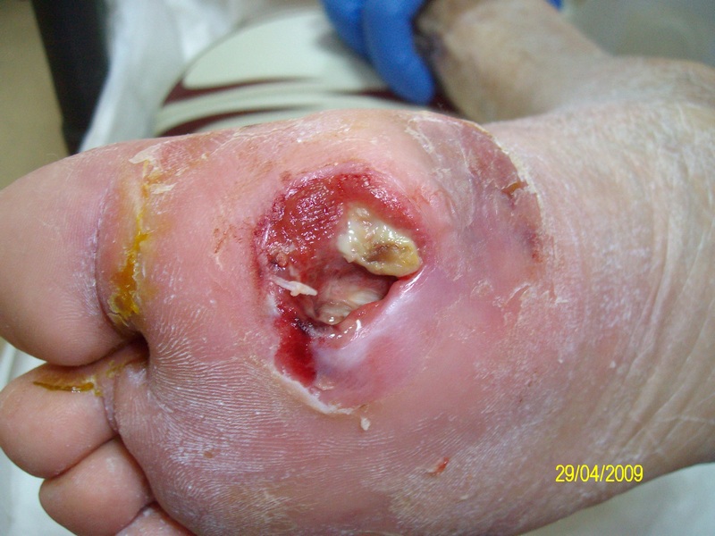 piede-diabetico